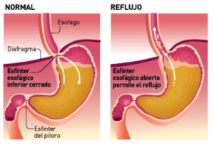 reflujo-gastroesofagico-1