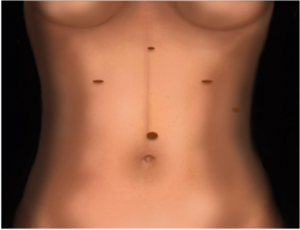 Así son las incisiones que se hacen en el abdomen en este tratamiento quirúrgico